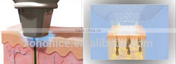 Y9C lumenis laser light 808nm diode laser hair removal