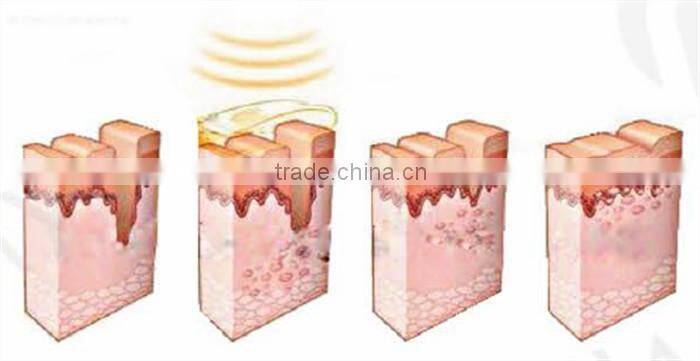 Factory direct supply- Professional IPL laser hair removal beauty machine