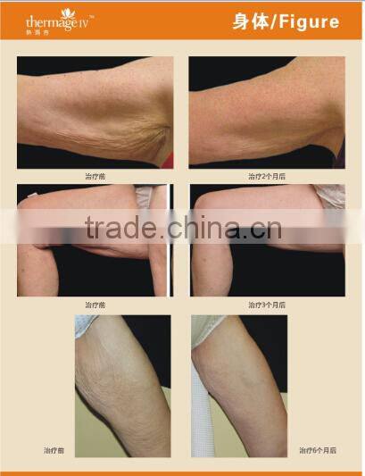 rf beauty machine rf equipment rf home use face lift devices AYJ-T28 CE