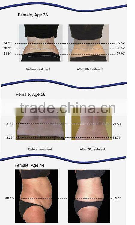 Slimming devices ultra cavitation cellulite treatment device for home use