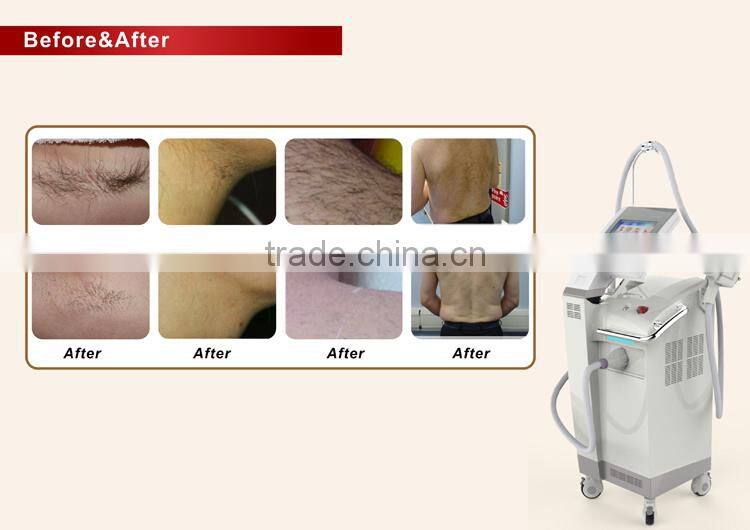 Popular Q-Switch ND Yag Laser Hair Removal Long Pulse LPUS-II