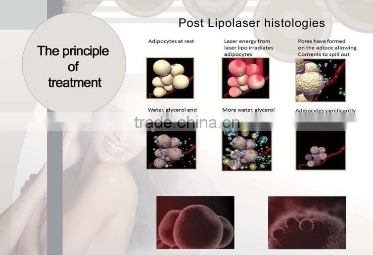 CE approved lipolaser