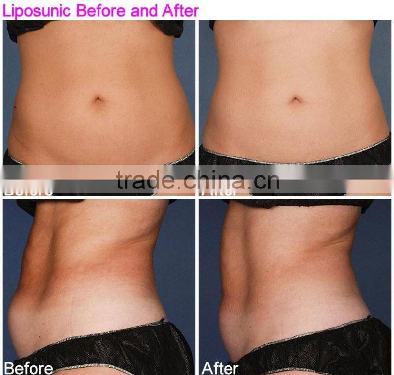 2016 best slimming technology liposunic slimming machine