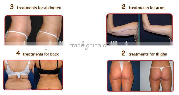 best selling weight loss machine cavitation rf lipo laser