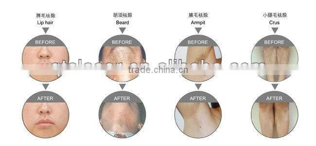 2013 New design E-light+IPL+RF machine Beauty machine light sheer duet depilator