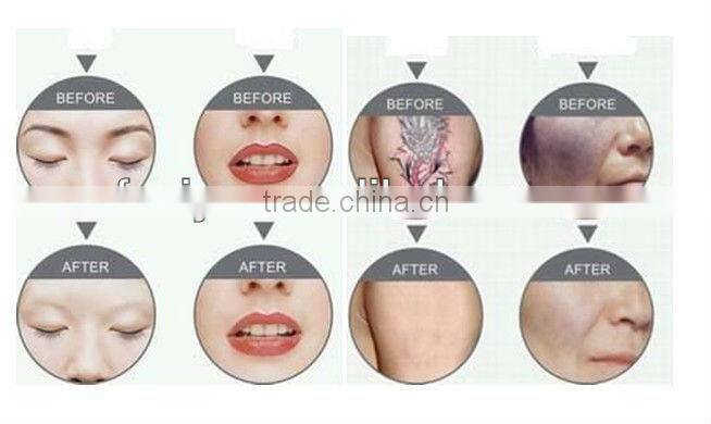 VY-LS450 Q switch laser tattoo removal machine price