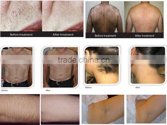 permanent body hair removal diode laser hair removal system