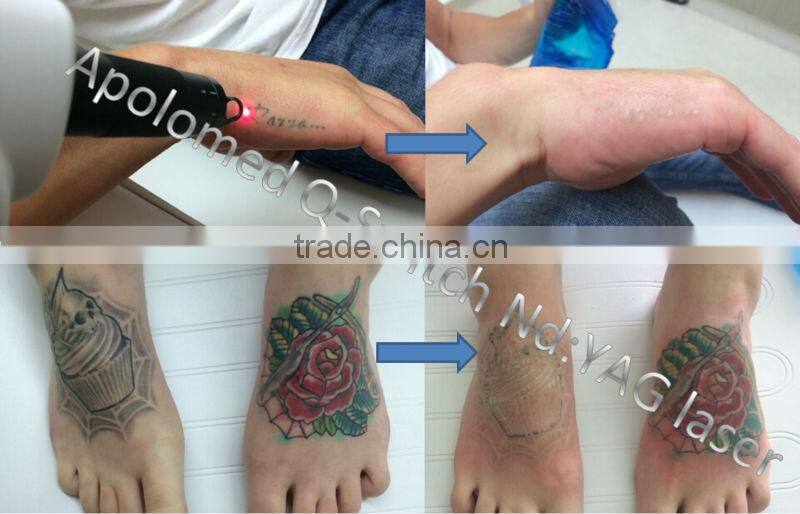 Apolomed ISO CE approved tattoo removal