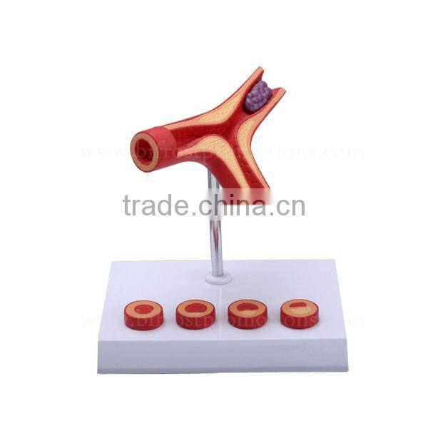 Thrombus Education Biological Teaching Human Body Anatomy Model