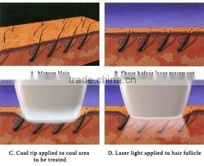 Free shipping and hot selling epilia diode laser hair removal for painless hair removal