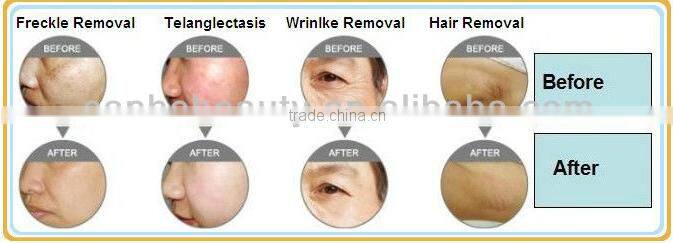 2016 SHR950B ipl shr elight machine/hair removal skin refreshing/ipl shr rf photodepilation