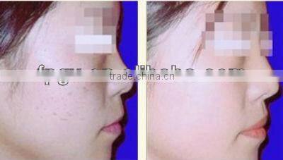 New Arrival IPL SHR Skin Rejuvenation RF Anti Wrinkle 2in1 Beauty Machine