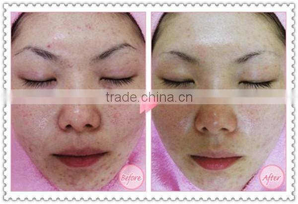 Hot selling medical microdermabrasion machine