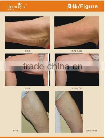 AYJ-C19(CE) Dot matrix portable rf thermagic galvanic facial machine