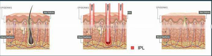 E6S Multifunction Beauty Machine IPL RF Laser ND YAG for Tattoo Removal
