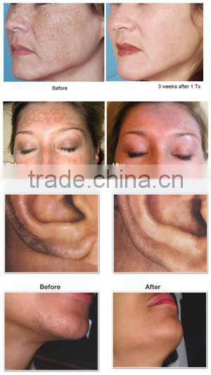 spa equipment ipl photoderm skin rejuvenation equipment ipl manufacturer