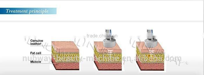 Trend 2015 High Intensity Focus Ultrasound Hifu For Bodi Slim