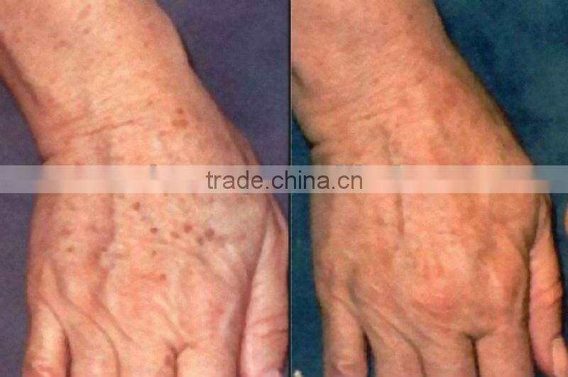 Professional IPL hair removal beauty machine AP-TK