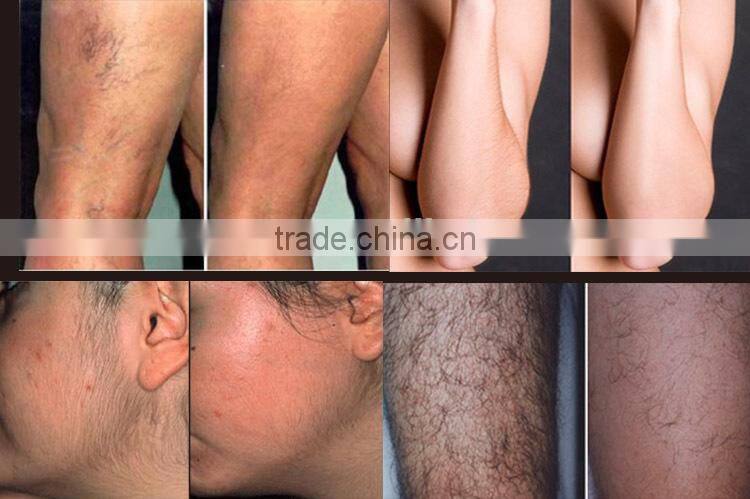 2016 hot promotion ipl pigment fast removal electric hair removal