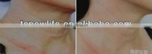 NL-TM800/ Guangzhou Newlife factory/newest design/ RF skin rejuvenation machine/fractional RF