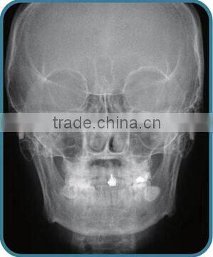 China Cheap Dental Panoramic and Cephalometric X-ray Machine
