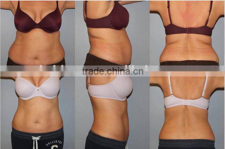 2016 hot product fat freeze criolipolisis professional/handle for criolipolisis