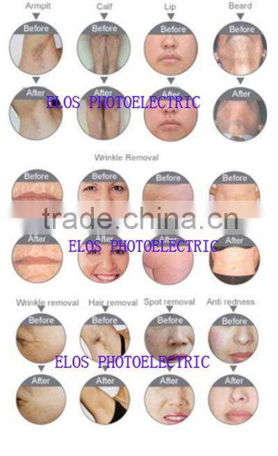 e-light ipl+rf machine for hair removal skin rejuvenation CE certificate