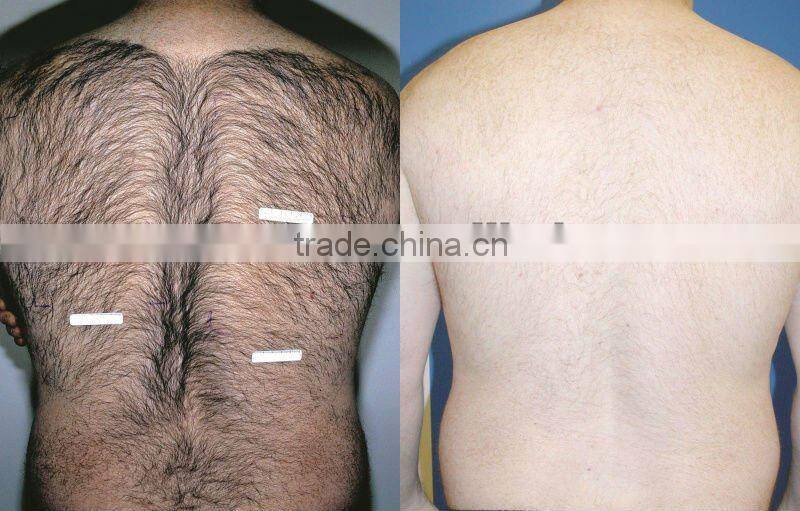 1064 laser permanently Hair remover for women P003