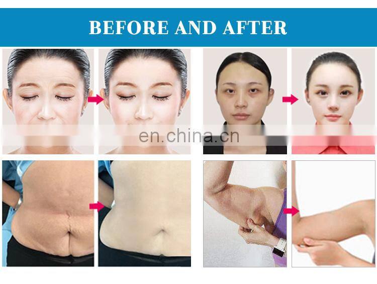 Portable 40K RF Body Weight Loss Body Slimming Cavitation Fat Removal Cellulite Ultrasound Machine