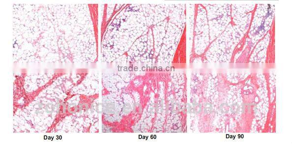 Portable Cryo lipo freeze weight loss freeze belt BD02