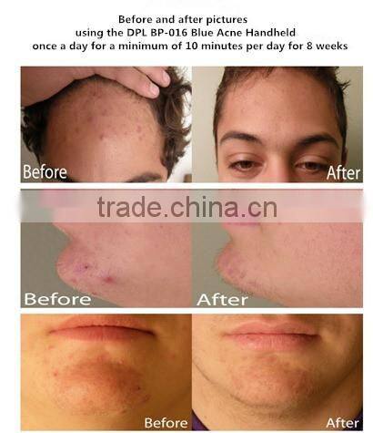 BP-016 NEW skin toning ipl photofacial machine for home use