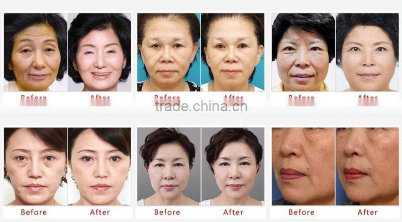 Factory direct selling Low price 3 head pieces 1.5mm&3.0mm&4.5mm hifu face machine anti-aging machine