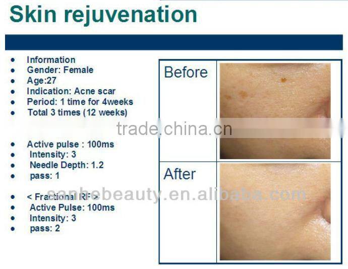 Pinxel-2 fractional rf microneedle/bipolar fractional rf microneedle machine/ce approved rf fractional microneedle