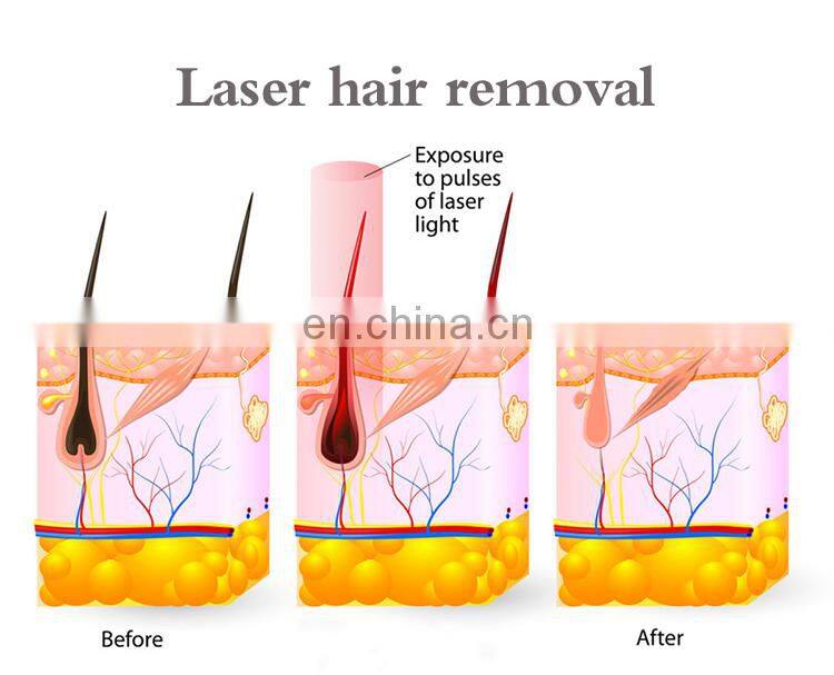 Renlang 808nm diode laser hair remover system 808 nm