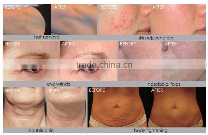 WRINKLE REMOVAL Skin tightening lipo laser Fractional RF machine