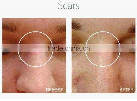 Noninvasive skin treatments derma needle reviews 1080 derma roller