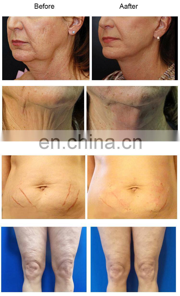 Effective Multidimensional cog thread face lift equipment face products eyes forehead wrinkles mono 30mm pdo lifting filler