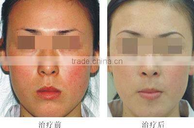 hotest soon spa laser aesthetic apparatus