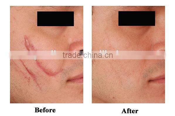 Glass Tube Co2 Fractional Laser Wrinkle Removal Machine Alibaba