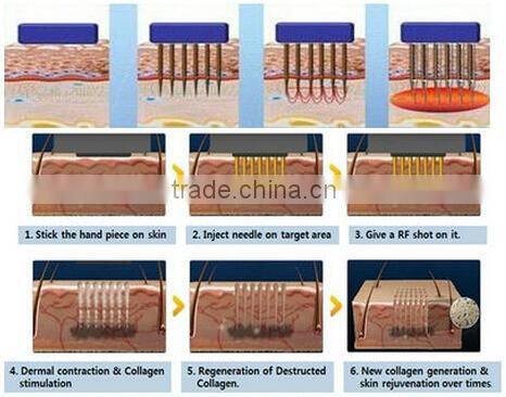 Portable fractional rf microneedle machine for skin fractional rf thermolysis device