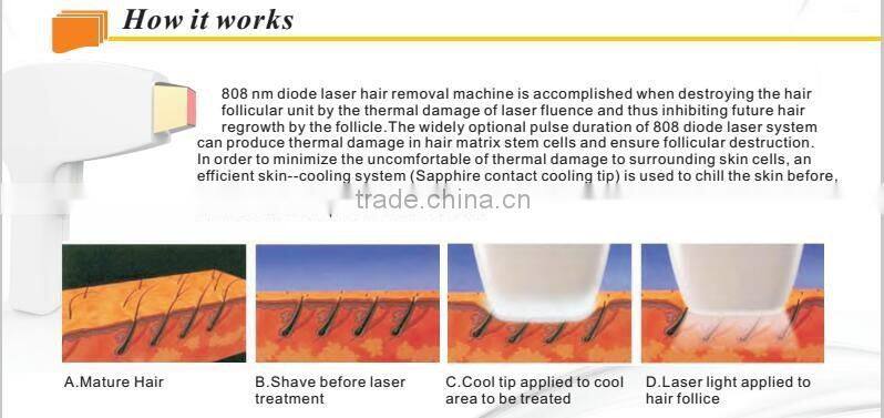 Best technology Hot sale 808nm diode laser for beauty salon
