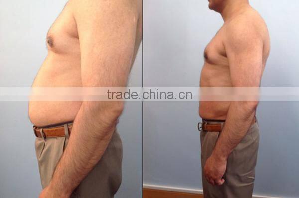 ultrasonic weight loss treatment ultrashape fda