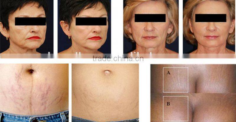 oxygen jet peel pdt microcurrent machine