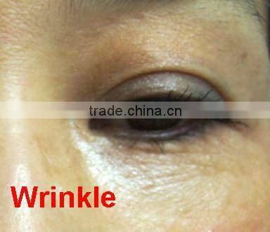eye bag-dark circle -skin lifting around eyes -eye care system