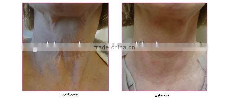 cheapest Israel viora reaction reaction beauty machine