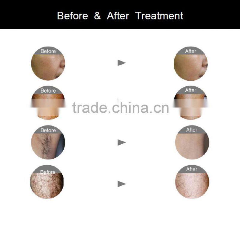 808nm Diode Laser Hair Removal Machine/Supply OEM&ODM Spare Parts