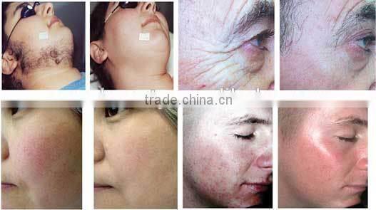 Hot sale SHR beauty equipment improve facial micro-circulation, IPL SHR hair removal beauty machine for sale - A011