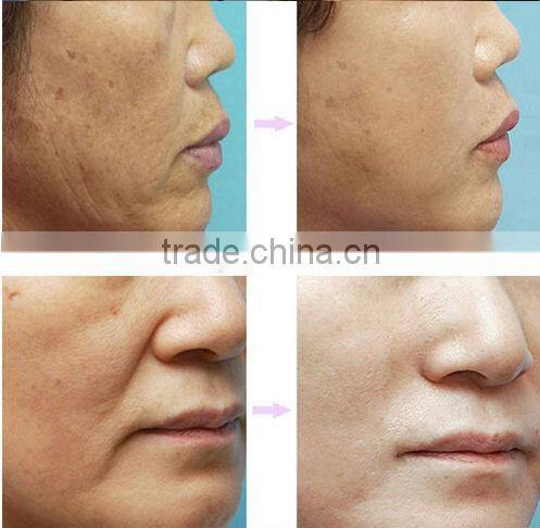 540 needles Microneedle derma roller Improve skin and delicate L005