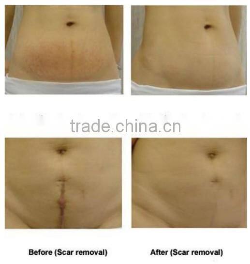 Professional Co2 Fractional Laser Skin Resurfacing Equipment