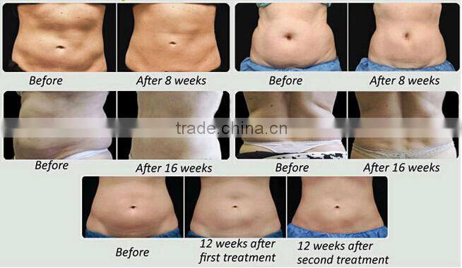 Multifunctional cryolipolysis+ rf +cavitation + vacuum cryolipolysis slimming machine
